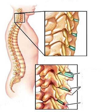 Comparația unei vertebre sănătoase și bolnave la nivelul gâtului
